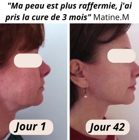 Les 5 meilleurs traitements esthétiques pour réduire le double menton avec ou sans chirurgie
