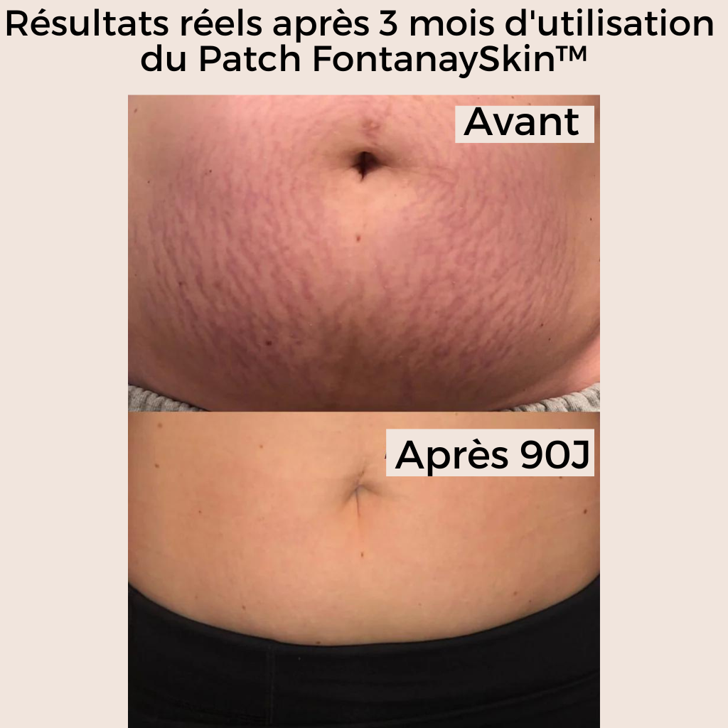 Patchs Corps Vergetures et Cellulite Réutilisables FontanaySkin™