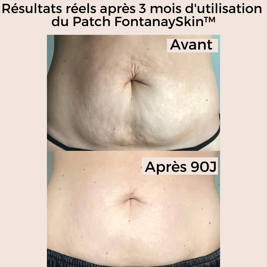 Patchs Corps Vergetures et Cellulite Réutilisables FontanaySkin™