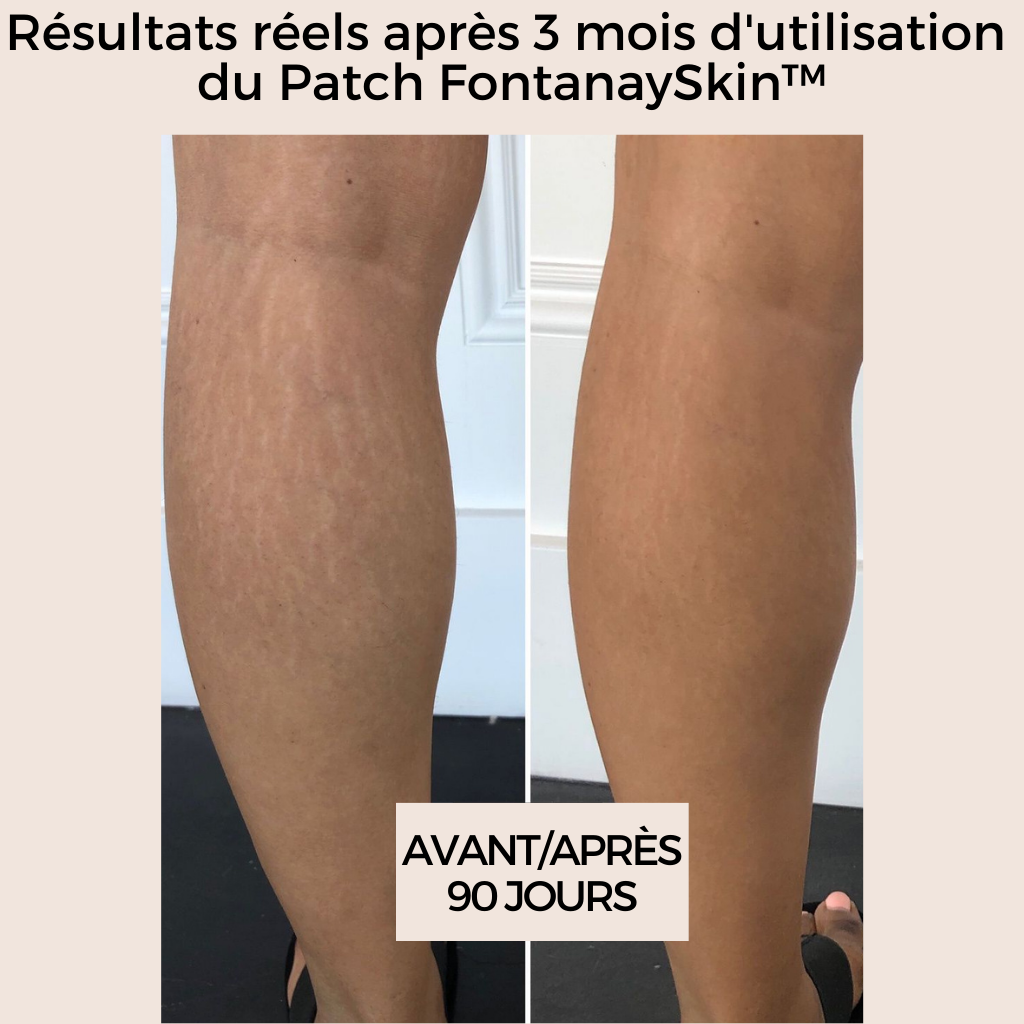 Patchs Corps Vergetures et Cellulite Réutilisables FontanaySkin™