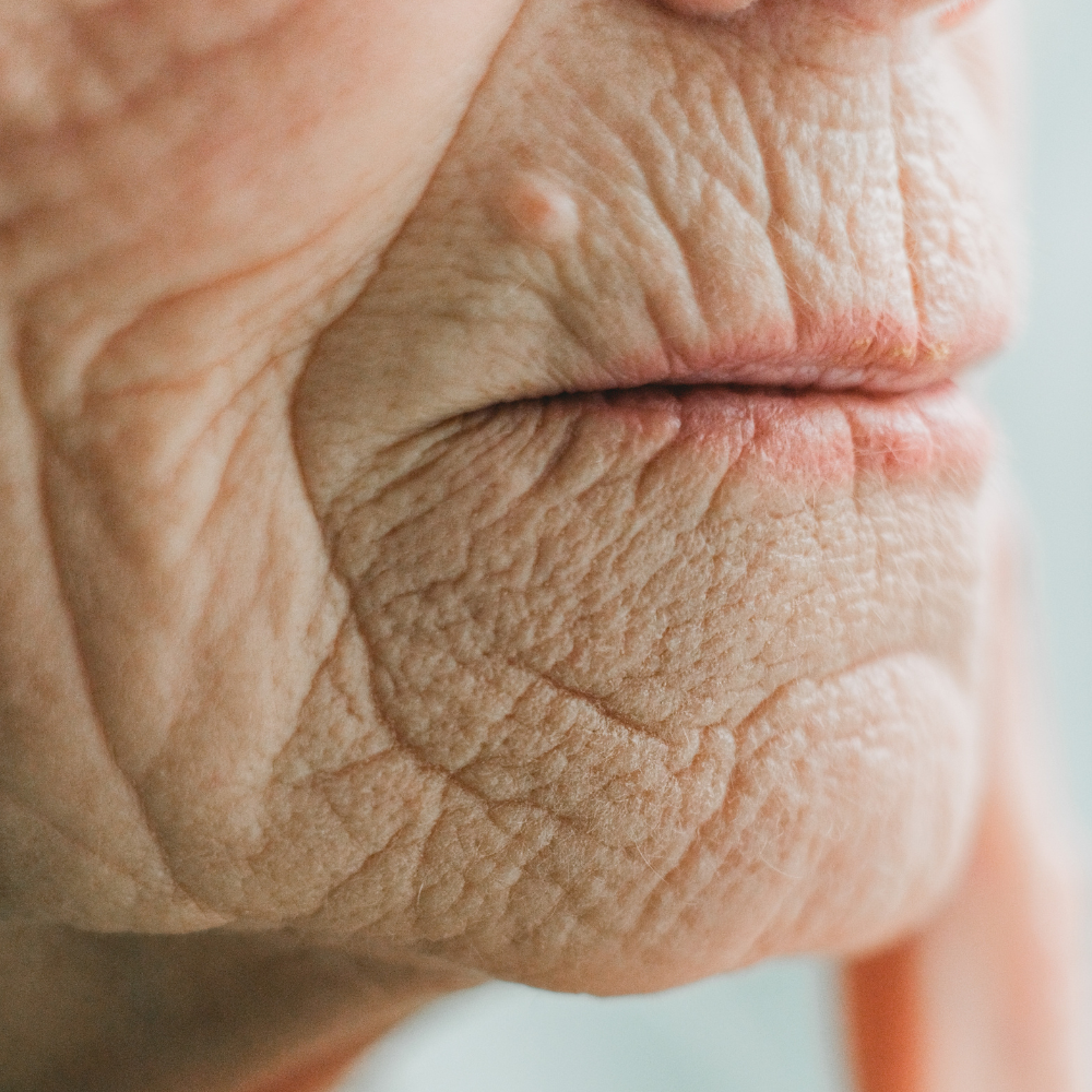 Les causes courantes des rides autour de la bouche et comment les prévenir