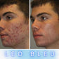 Masque LED Thérapie Pro